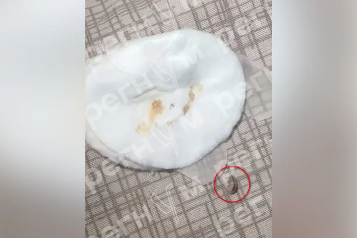 Укус мухи обернулся кошмаром: личинка в груди сибирячки
